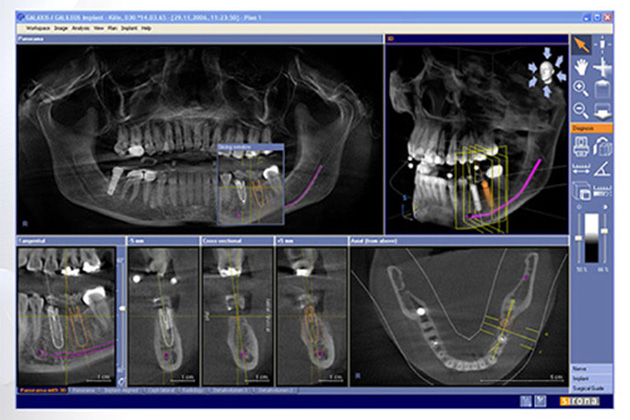 マイクロスコープ・歯科用CTを用いた精密治療
