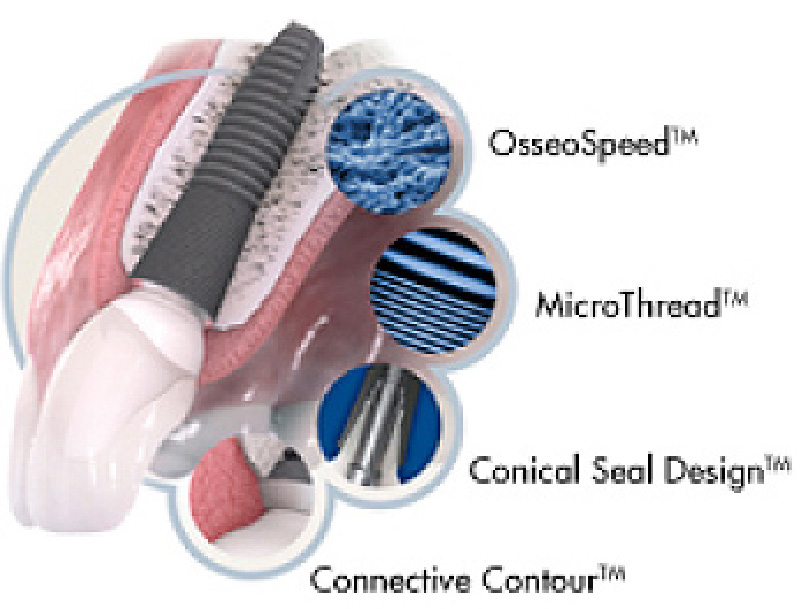 Astra Tech Implant System
